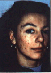 Before Microdermabrasion